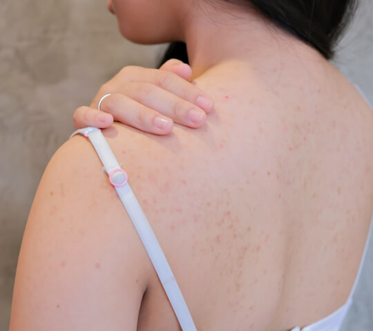 Achieve Clear Skin with Natural Remedies for Back Acne